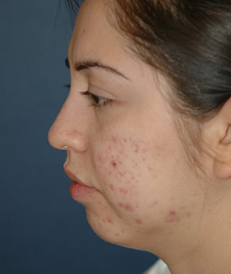 Chin Augmentation Before & After Gallery - Patient 156883 - Image 7