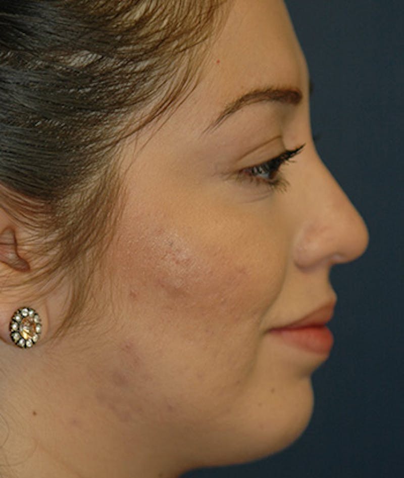 Chin Augmentation Before & After Gallery - Patient 156883 - Image 6