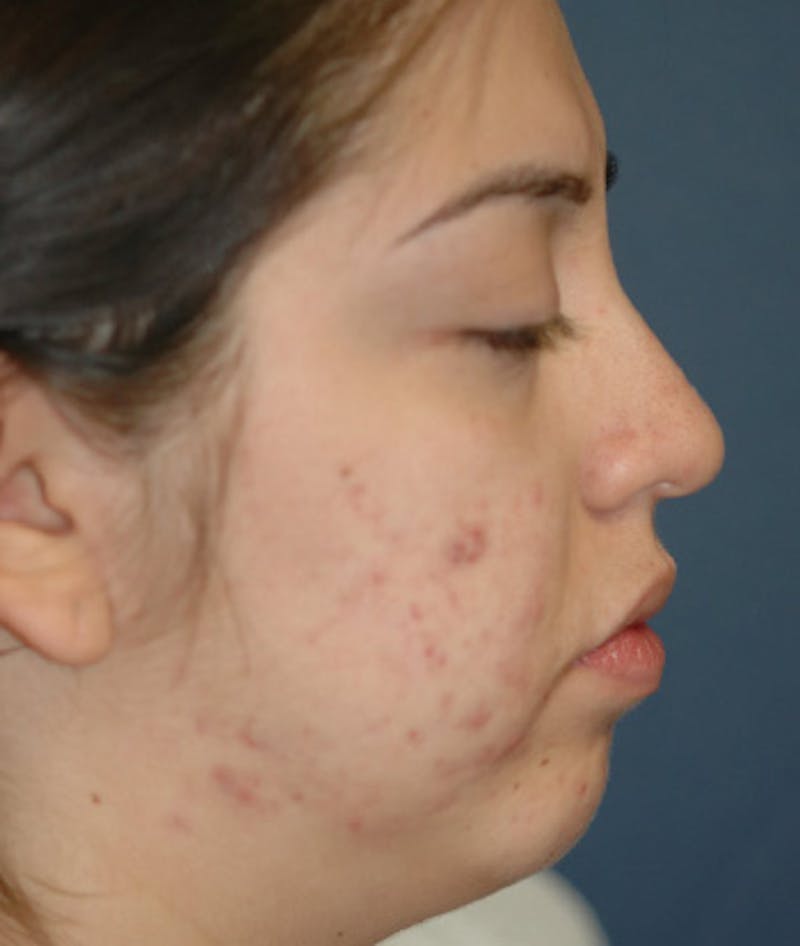 Chin Augmentation Before & After Gallery - Patient 156883 - Image 5