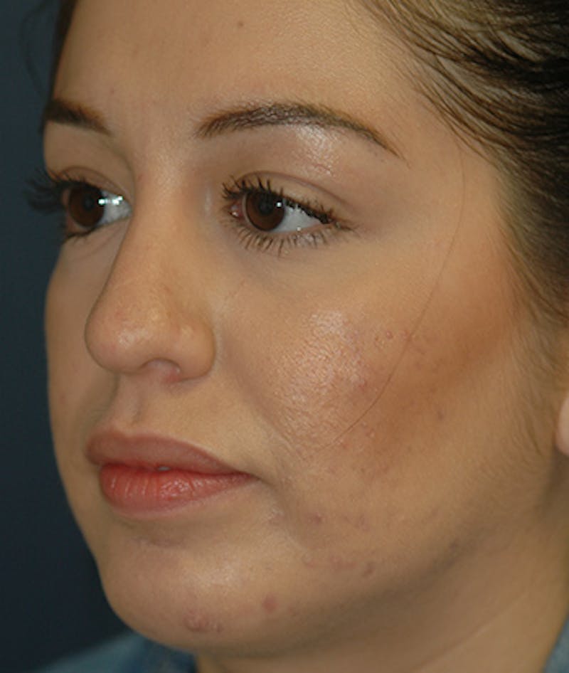 Chin Augmentation Before & After Gallery - Patient 156883 - Image 4