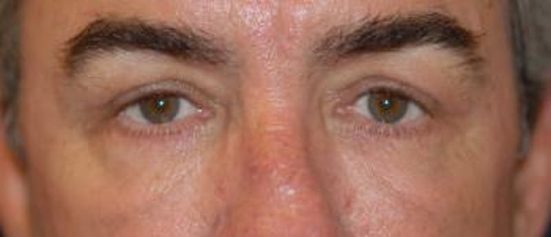 Eyelid Lift (Blepharoplasty) Before & After Gallery - Patient 322762 - Image 4
