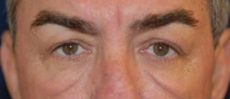 Eyelid Lift (Blepharoplasty) Before & After Gallery - Patient 322762 - Image 3