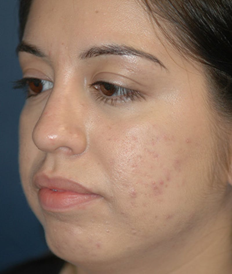 Chin Augmentation Before & After Gallery - Patient 156883 - Image 3