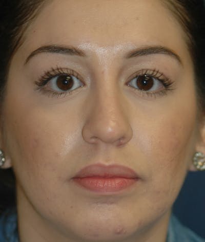 Chin Augmentation Before & After Gallery - Patient 156883 - Image 2