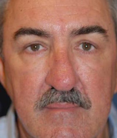 Eyelid Lift (Blepharoplasty) Before & After Gallery - Patient 322762 - Image 2