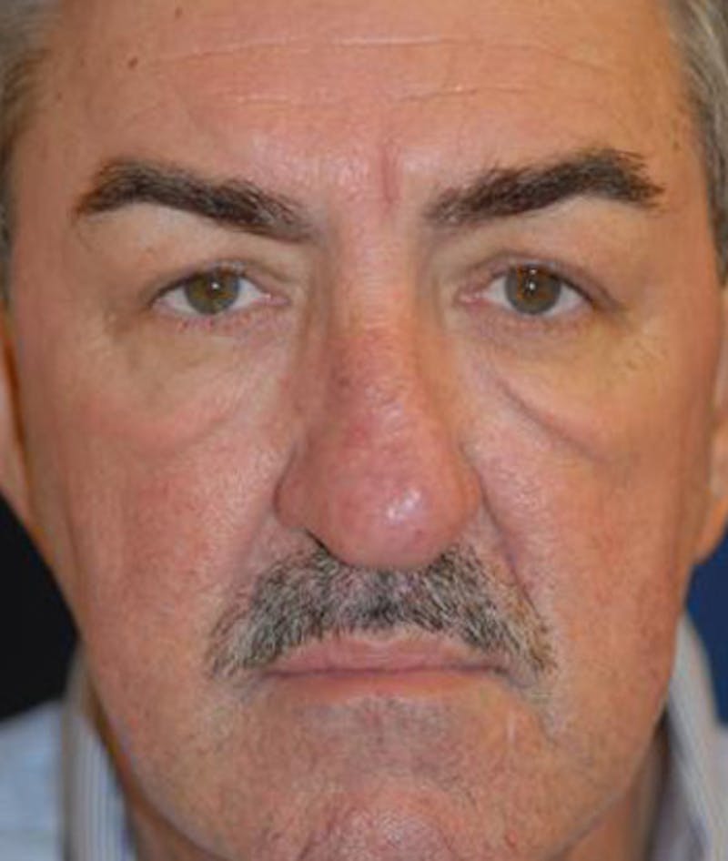 Eyelid Lift (Blepharoplasty) Before & After Gallery - Patient 322762 - Image 1