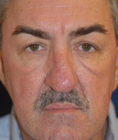 Eyelid Lift (Blepharoplasty) Before & After Gallery - Patient 322762 - Image 1
