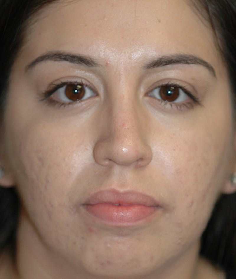 Chin Augmentation Before & After Gallery - Patient 156883 - Image 1