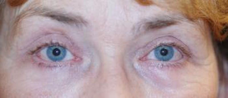 Eyelid Lift (Blepharoplasty) Before & After Gallery - Patient 101016 - Image 4