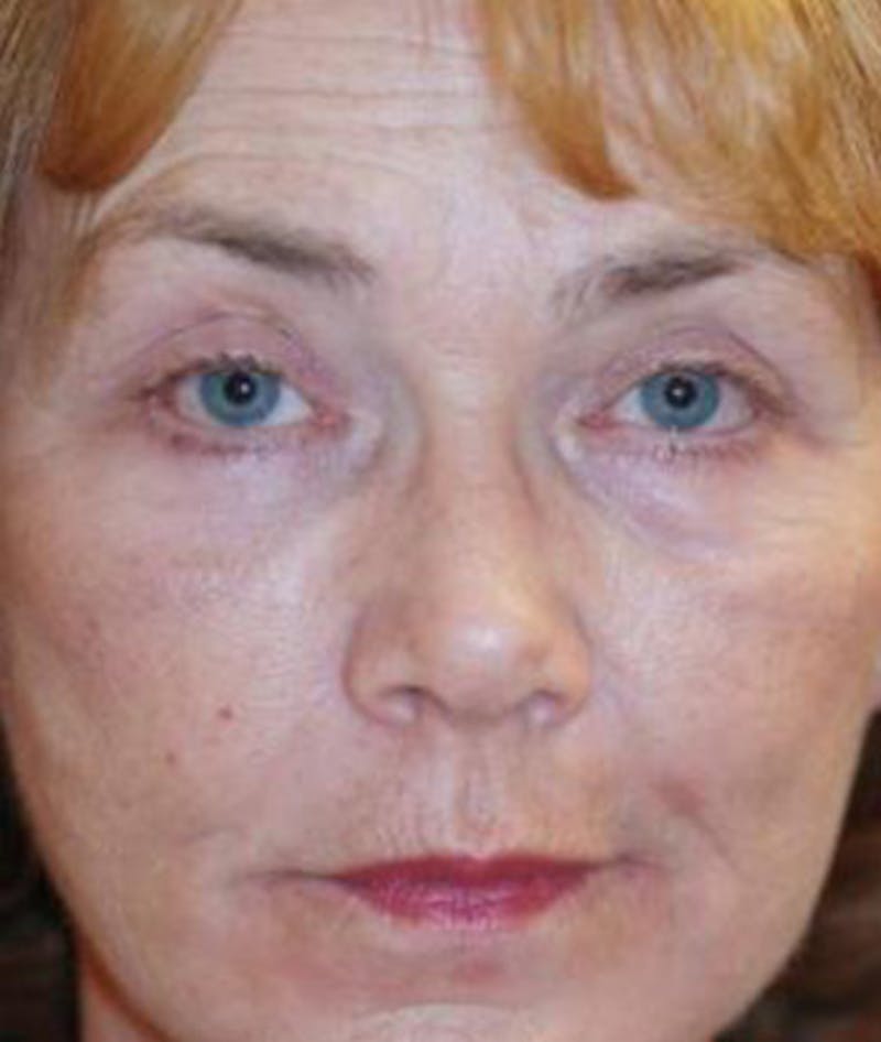 Eyelid Lift (Blepharoplasty) Before & After Gallery - Patient 101016 - Image 2