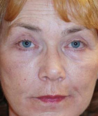 Eyelid Lift (Blepharoplasty) Before & After Gallery - Patient 101016 - Image 2