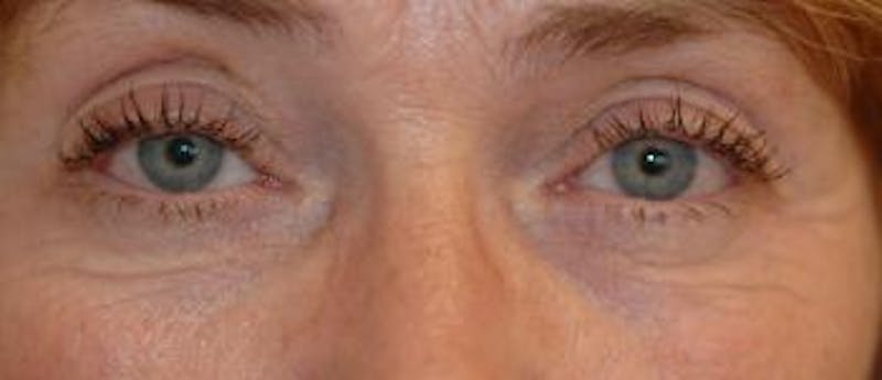 Eyelid Lift (Blepharoplasty) Before & After Gallery - Patient 101016 - Image 3