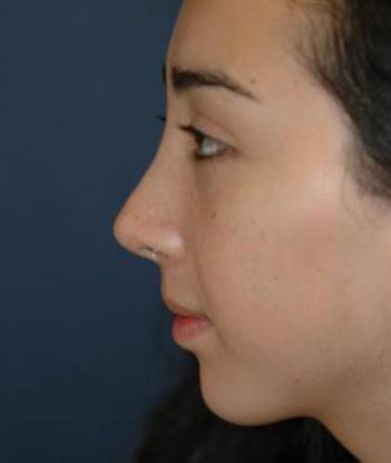 Chin Augmentation Before & After Gallery - Patient 132319 - Image 4