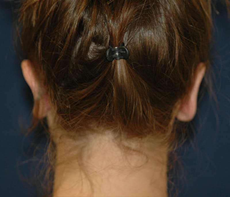 Ear Pinning (Otoplasty) Before & After Gallery - Patient 141146 - Image 4