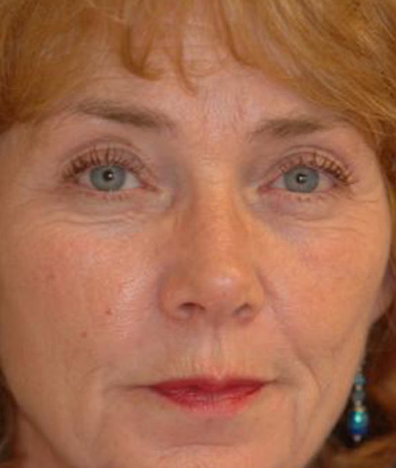 Eyelid Lift (Blepharoplasty) Before & After Gallery - Patient 101016 - Image 1