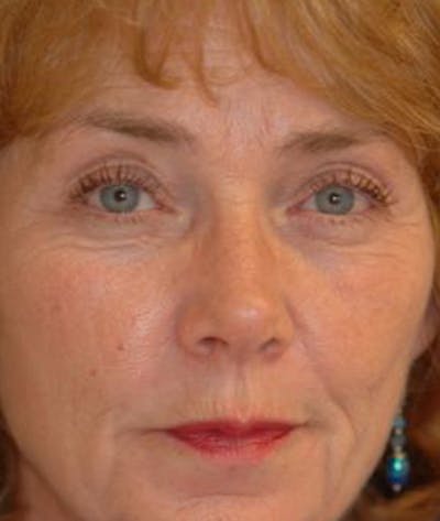 Eyelid Lift (Blepharoplasty) Before & After Gallery - Patient 101016 - Image 1