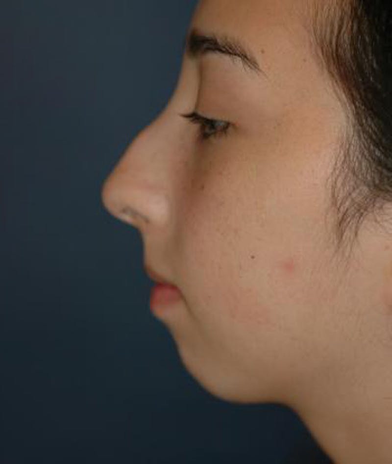 Chin Augmentation Before & After Gallery - Patient 132319 - Image 3