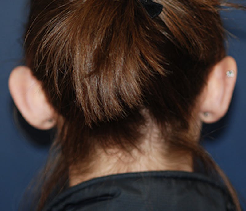 Ear Pinning (Otoplasty) Before & After Gallery - Patient 141146 - Image 3