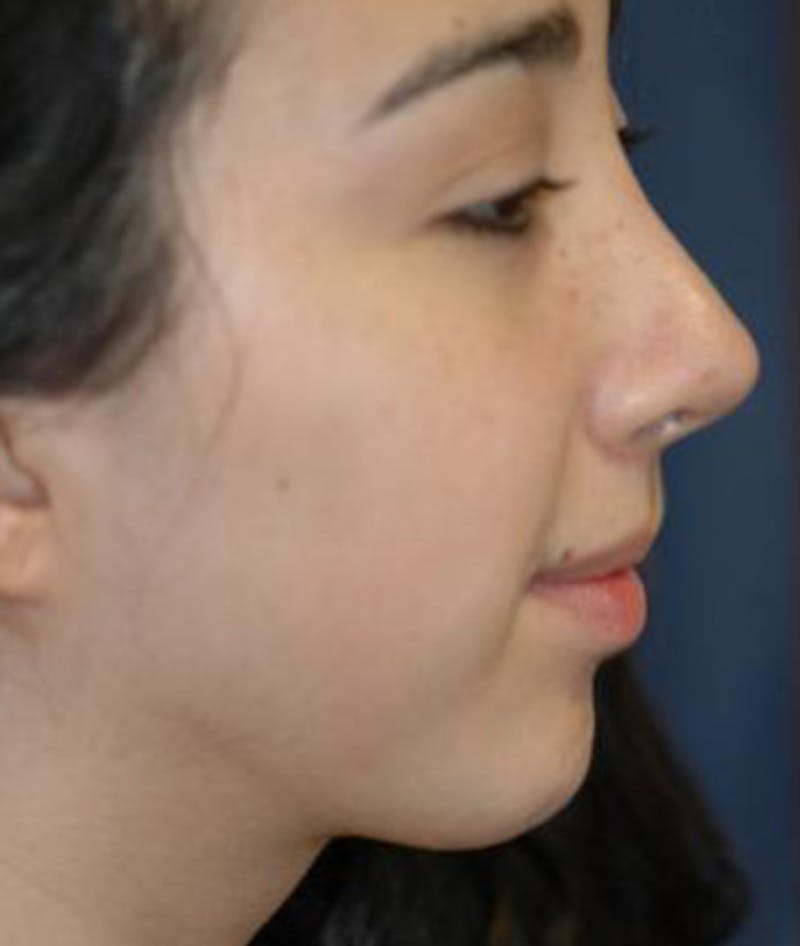 Chin Augmentation Before & After Gallery - Patient 132319 - Image 2
