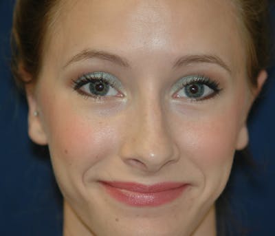 Ear Pinning (Otoplasty) Before & After Gallery - Patient 141146 - Image 2