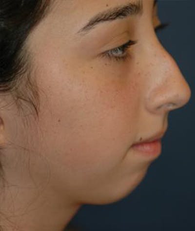 Chin Augmentation Before & After Gallery - Patient 132319 - Image 1