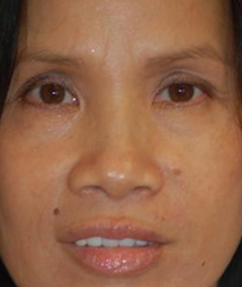 Browlift Before & After Gallery - Patient 600449 - Image 1