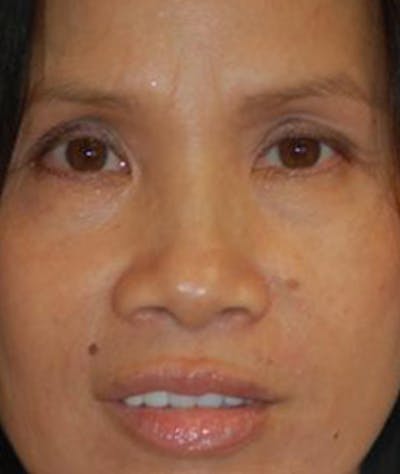 Eyelid Lift (Blepharoplasty) Before & After Gallery - Patient 302390 - Image 1