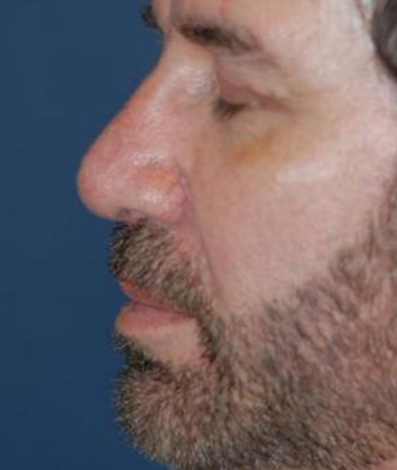 Chin Augmentation Before & After Gallery - Patient 821034 - Image 4
