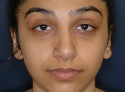 Ear Pinning (Otoplasty) Before & After Gallery - Patient 833349 - Image 2