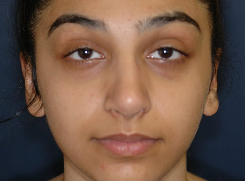 Ear Pinning (Otoplasty) Before & After Gallery - Patient 833349 - Image 2