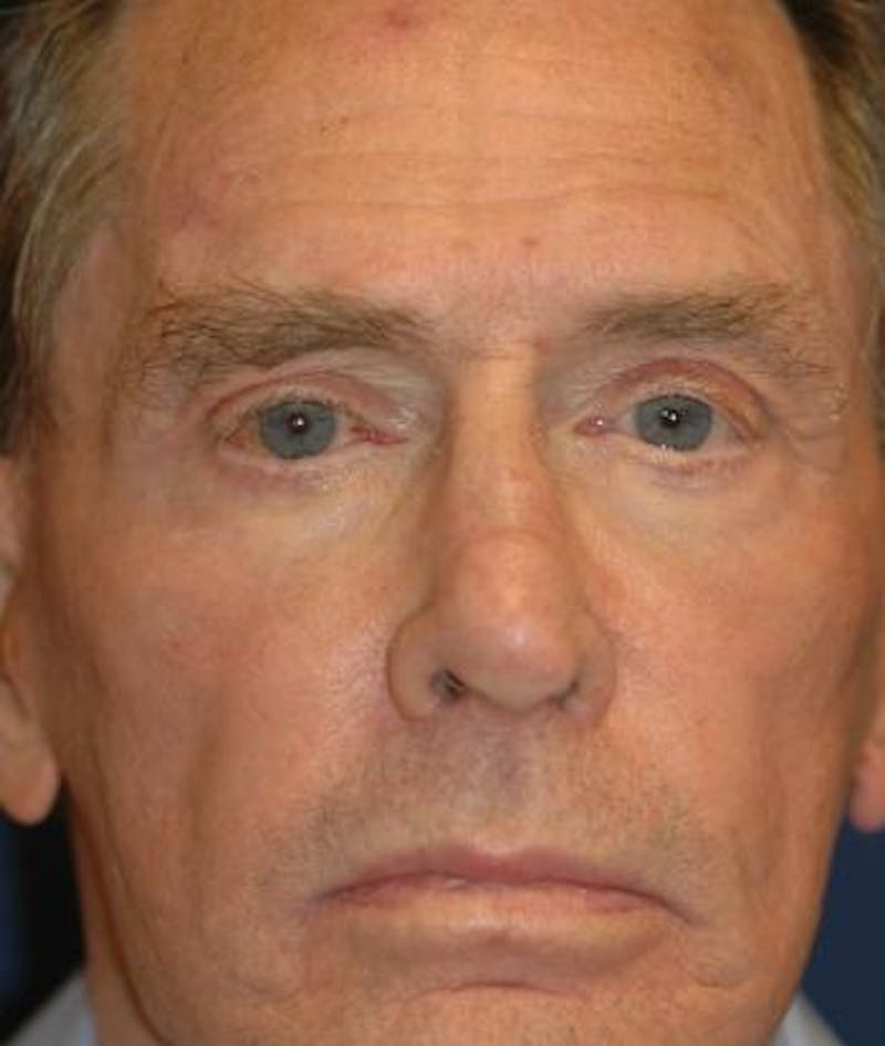 Eyelid Lift (Blepharoplasty) Before & After Gallery - Patient 198639 - Image 2