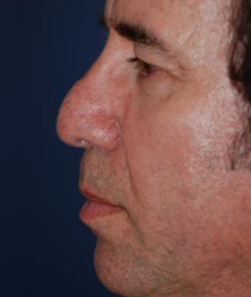 Chin Augmentation Before & After Gallery - Patient 821034 - Image 3
