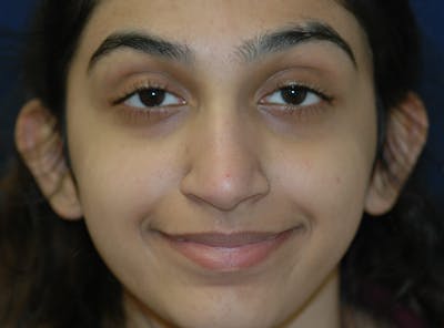 Ear Pinning (Otoplasty) Before & After Gallery - Patient 833349 - Image 1