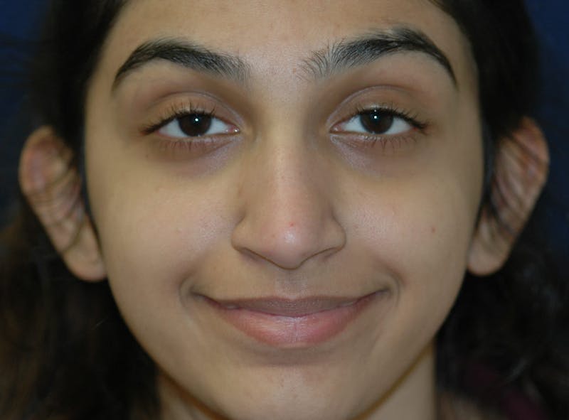Ear Pinning (Otoplasty) Before & After Gallery - Patient 833349 - Image 1