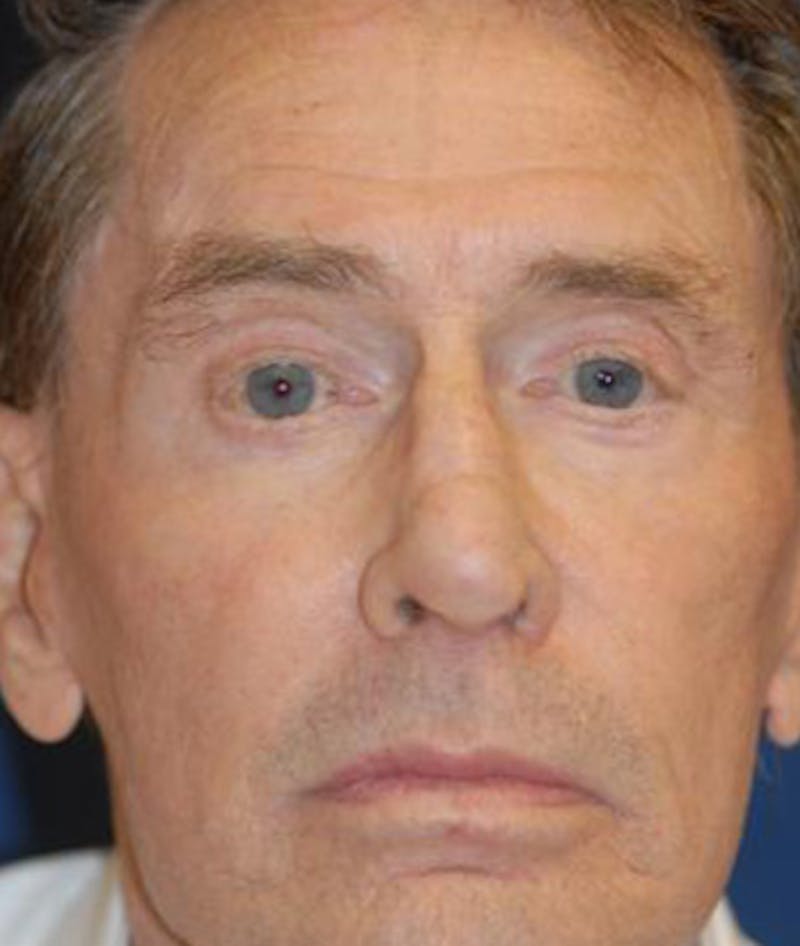 Eyelid Lift (Blepharoplasty) Before & After Gallery - Patient 198639 - Image 1