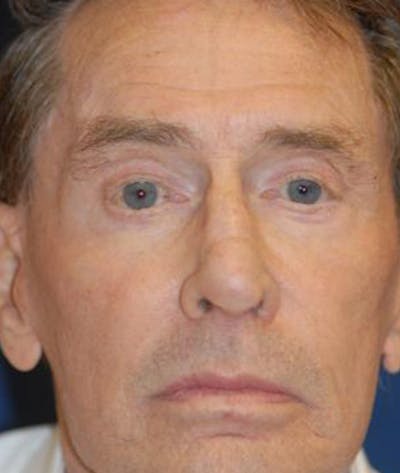 Eyelid Lift (Blepharoplasty) Before & After Gallery - Patient 198639 - Image 1
