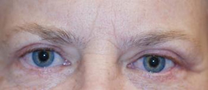 Eyelid Lift (Blepharoplasty) Before & After Gallery - Patient 772747 - Image 4