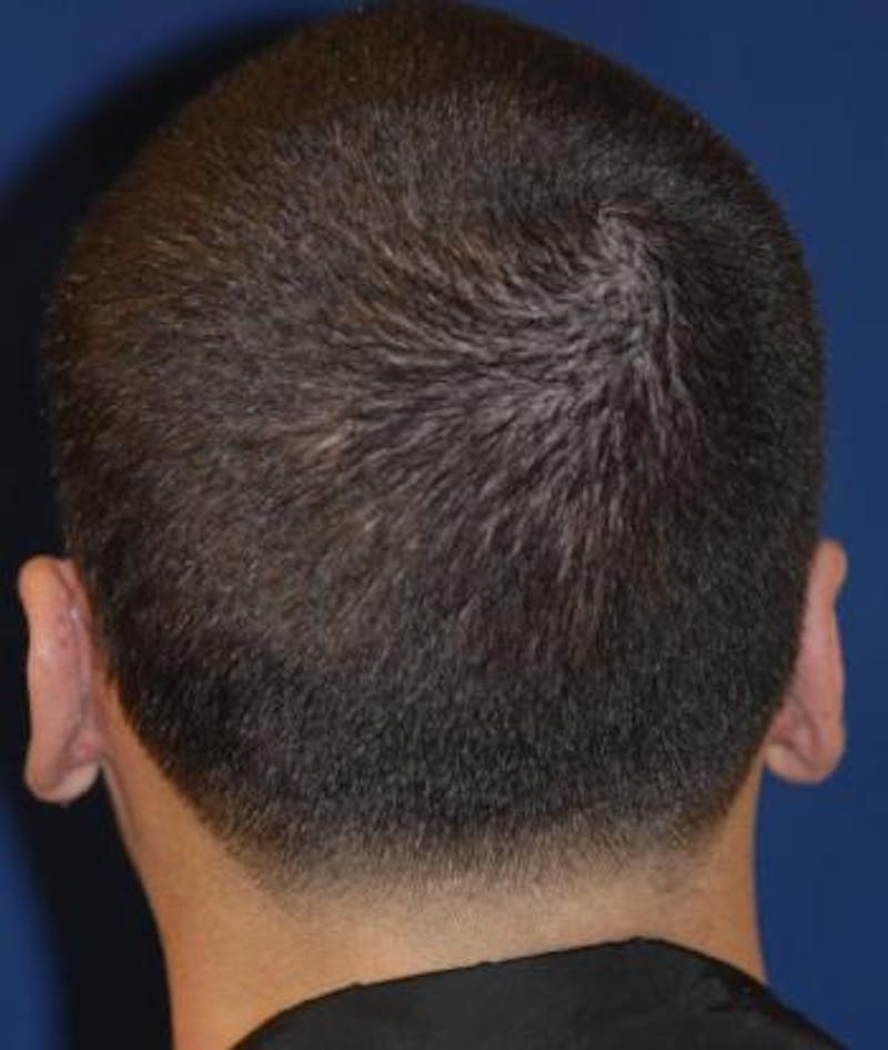 Ear Pinning (Otoplasty) Before & After Gallery - Patient 257966 - Image 4