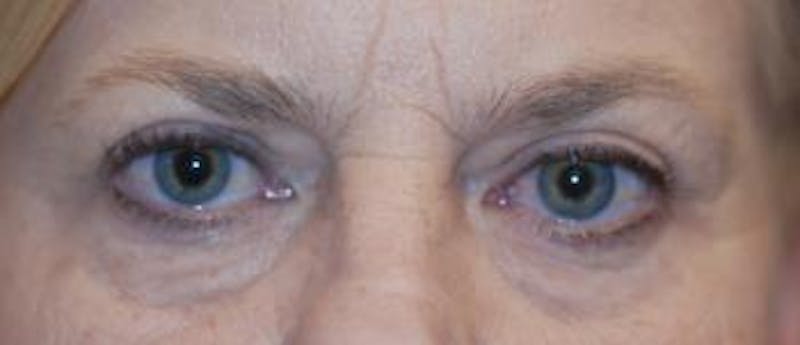 Eyelid Lift (Blepharoplasty) Before & After Gallery - Patient 772747 - Image 3