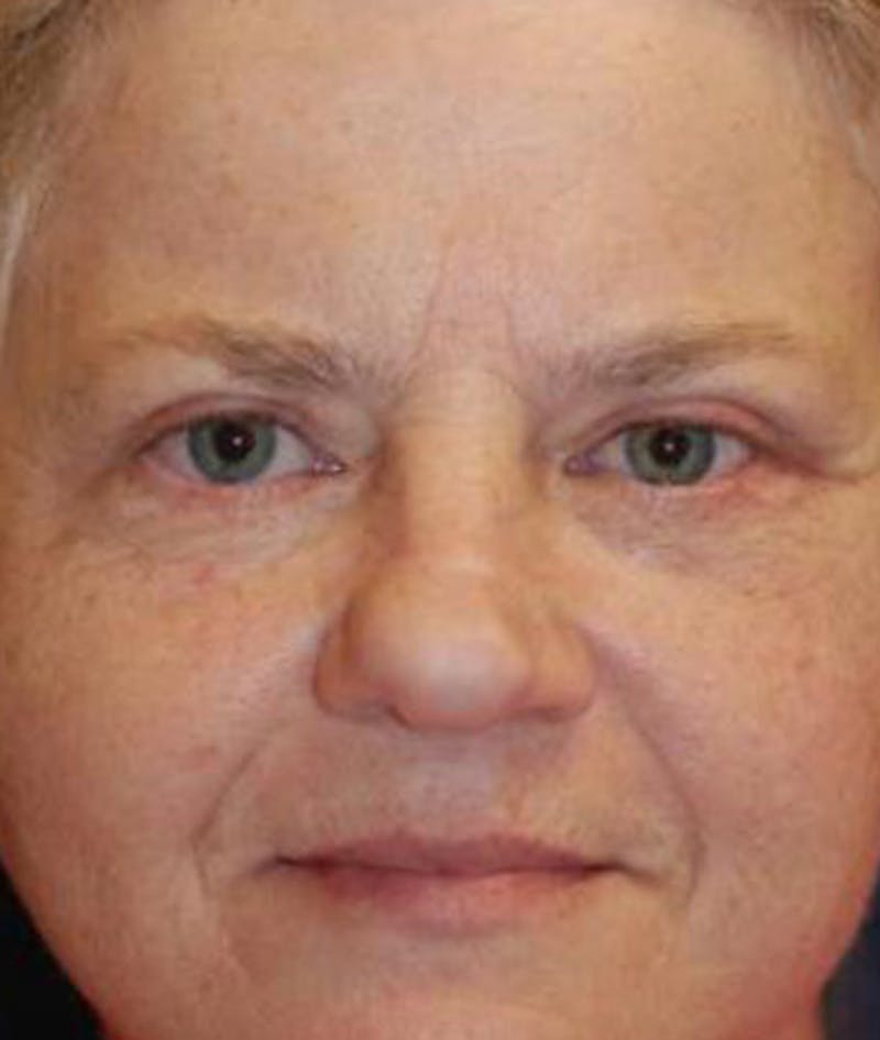 Eyelid Lift (Blepharoplasty) Before & After Gallery - Patient 772747 - Image 2