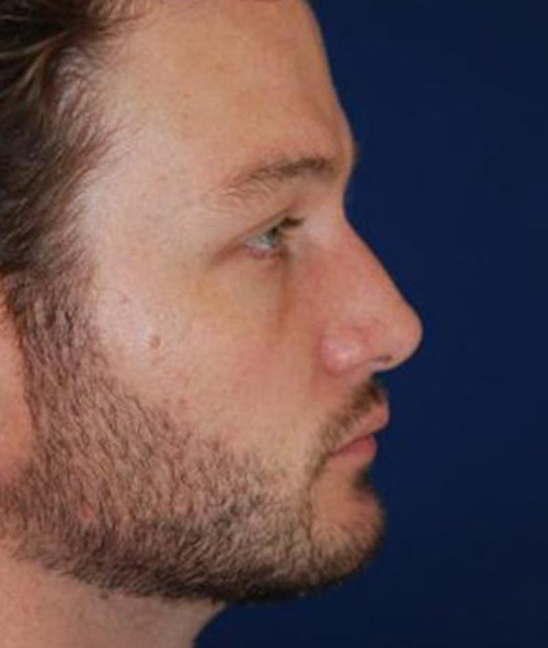 Chin Augmentation Before & After Gallery - Patient 291159 - Image 6