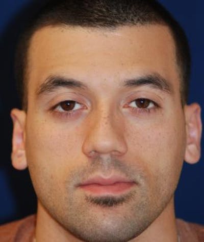 Ear Pinning (Otoplasty) Before & After Gallery - Patient 257966 - Image 2