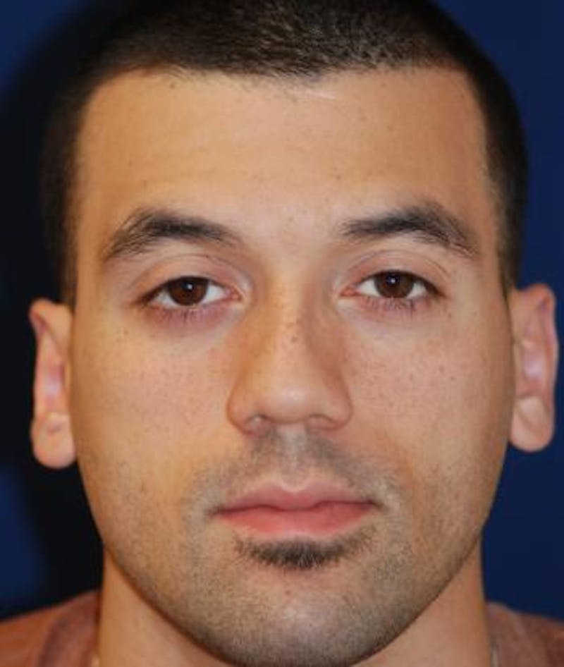 Ear Pinning (Otoplasty) Before & After Gallery - Patient 257966 - Image 2