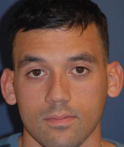Ear Pinning (Otoplasty) Before & After Gallery - Patient 257966 - Image 1