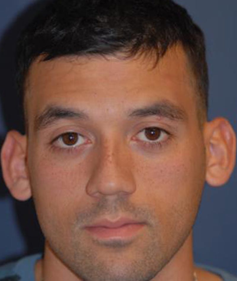 Ear Pinning (Otoplasty) Before & After Gallery - Patient 257966 - Image 1