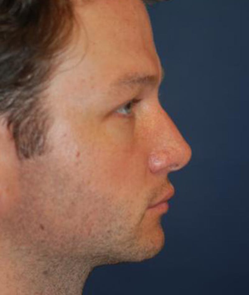 Chin Augmentation Before & After Gallery - Patient 291159 - Image 5
