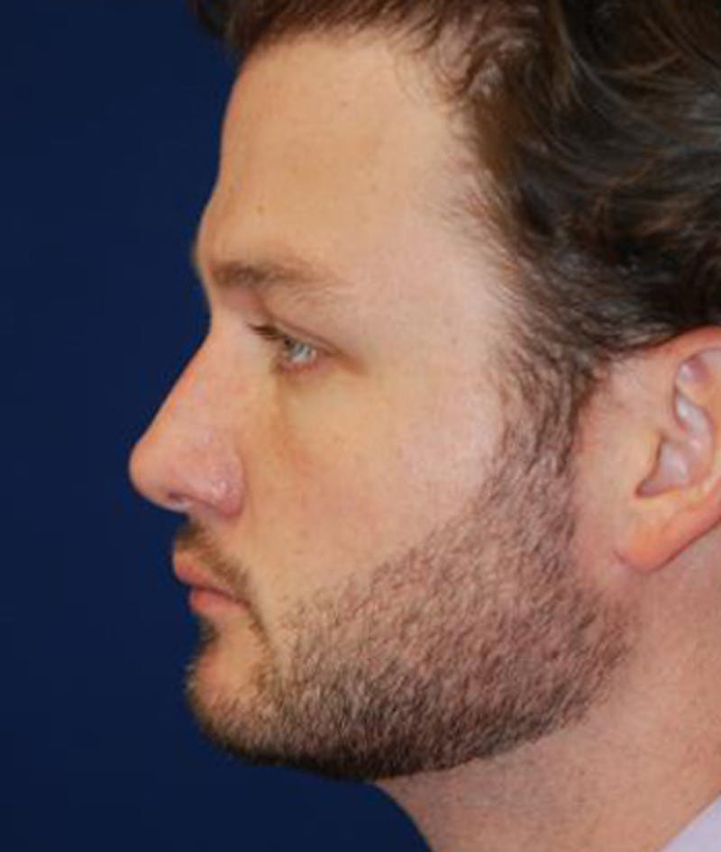 Chin Augmentation Before & After Gallery - Patient 291159 - Image 4