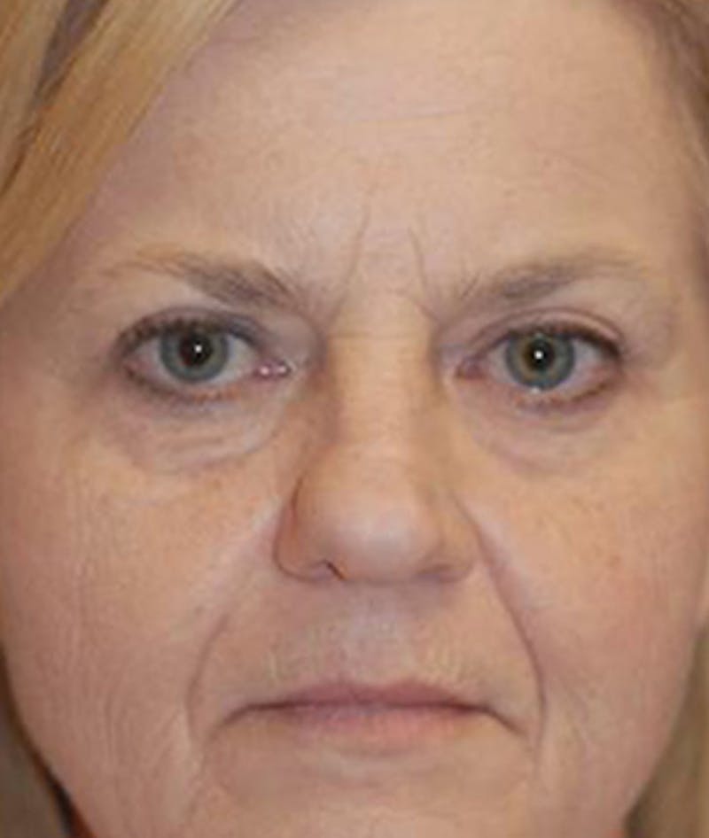 Eyelid Lift (Blepharoplasty) Before & After Gallery - Patient 772747 - Image 1