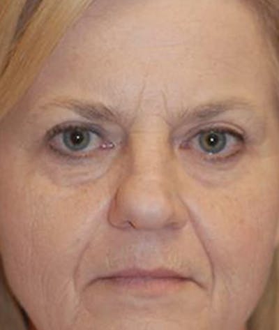 Eyelid Lift (Blepharoplasty) Before & After Gallery - Patient 772747 - Image 1