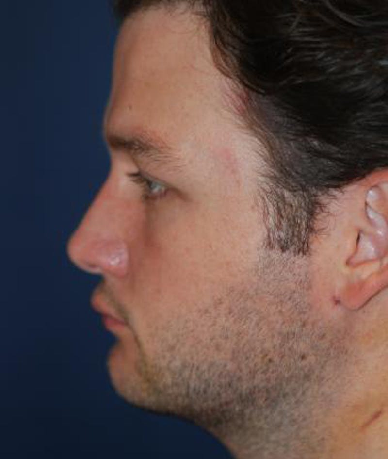 Chin Augmentation Before & After Gallery - Patient 291159 - Image 3
